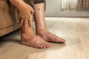 Don’t Ignore Swollen Feet and Ankles
