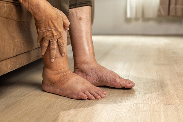 Don’t Ignore Swollen Feet and Ankles