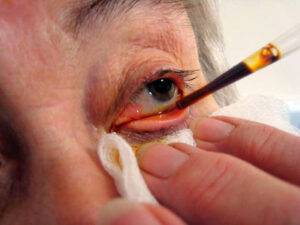 Don’t Put Up With Persistent Dry Eyes