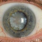 Cataracts Can Develop Slowly Without You Realising