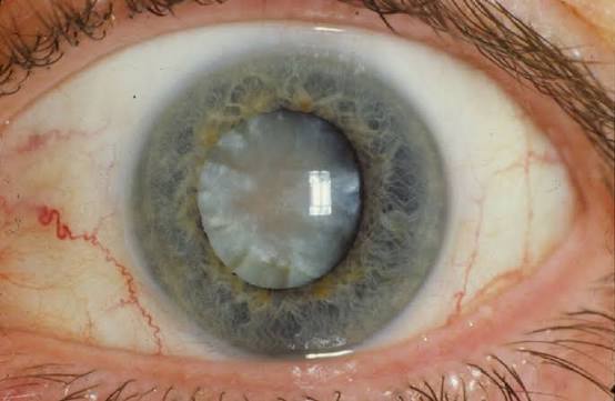 Cataracts Can Develop Slowly Without You Realising