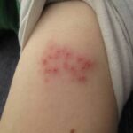 Shingles Is More Common Than Many People Realise