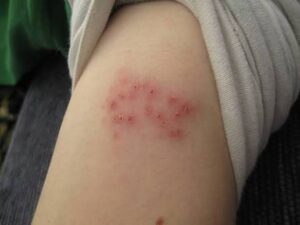 Shingles Is More Common Than Many People Realise