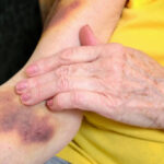 When a Bruise Seems to Appear Out of Nowhere