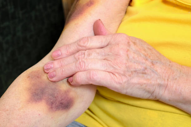 When a Bruise Seems to Appear Out of Nowhere