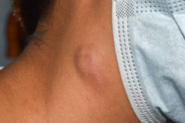 A New Lump in Your Neck Is Worth Noticing