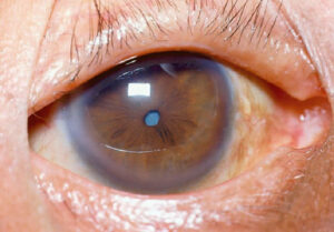 Could Cataracts Be Changing Your Vision?