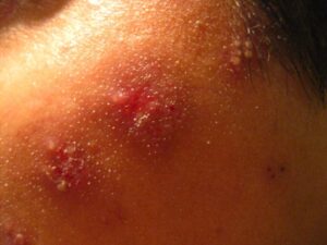 Shingles Can Start With Pain Before the Rash