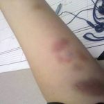 The Bruise That Appears Without a Knock