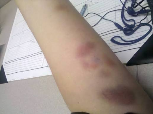 The Bruise That Appears Without a Knock