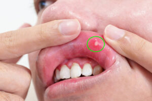 The Mouth Sore That Just Won’t Heal