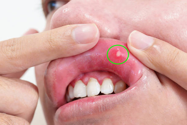 The Mouth Sore That Just Won’t Heal