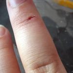 The Small Cut That Keeps Opening Again