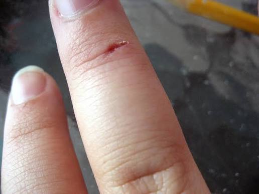 The Small Cut That Keeps Opening Again