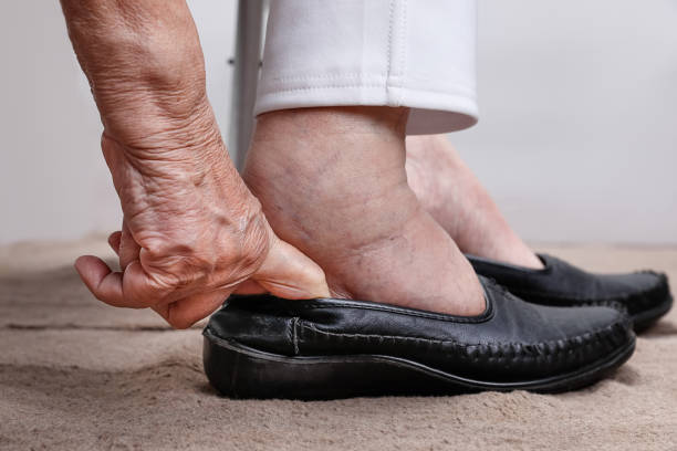 Those Swollen Ankles May Be Telling You Something
