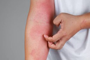 The Itch That Gets Worse After a Hot Shower