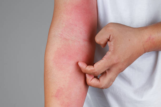 The Itch That Gets Worse After a Hot Shower
