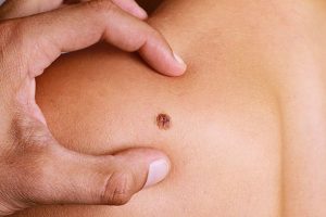 The Mole That Doesn’t Look Like the Others