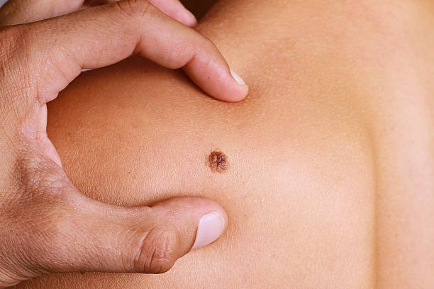 The Mole That Doesn’t Look Like the Others